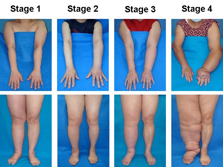 Stage of Lymphedema